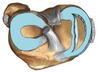 반월상 연골판 파열 이미지