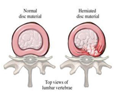 요추 추간판 탈출증 이미지